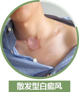散發(fā)型白癜風平時要注意哪些